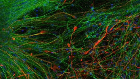 Brain cells derived from human skin cells, coloured green and orange.